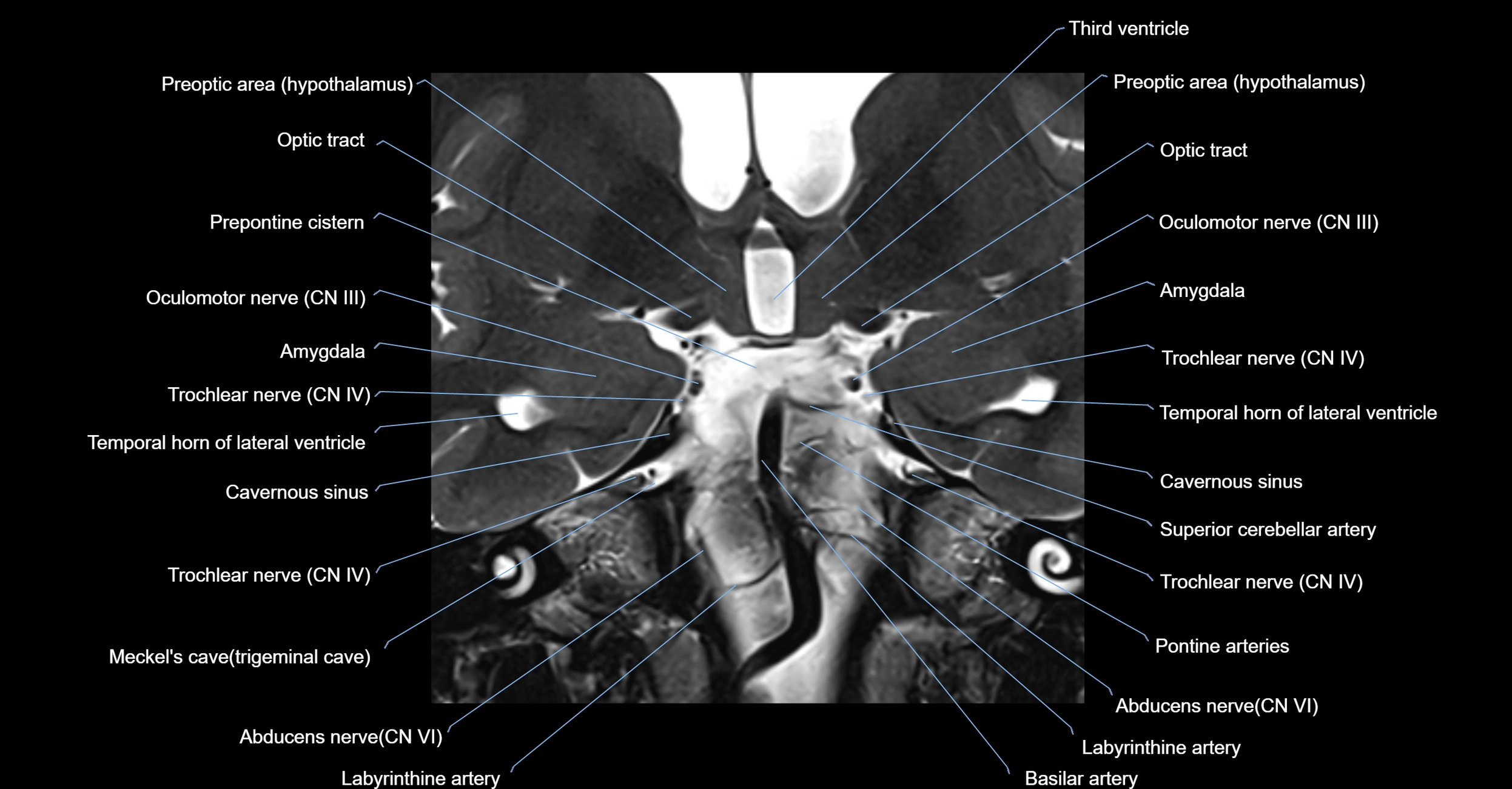 MRI cavernous sinus coronal cross sectional 3T anatomy image-img-00001-00016.webp